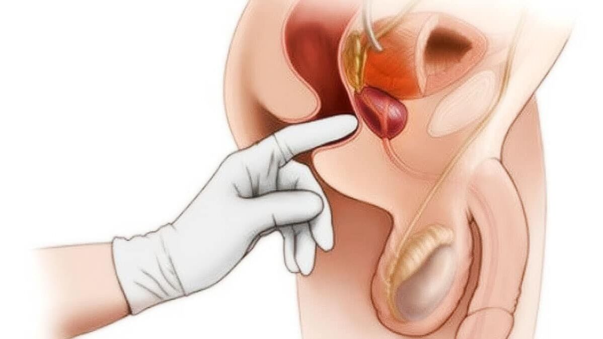diagnóstico da prostatite e o seu tratamento co dispositivo