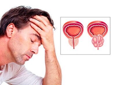 Os síntomas da prostatite preocupan a un home