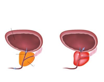 Próstata normal e inflamado