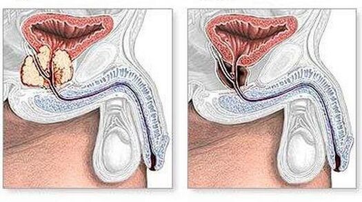 Antes e despois do tratamento cirúrxico da prostatite crónica